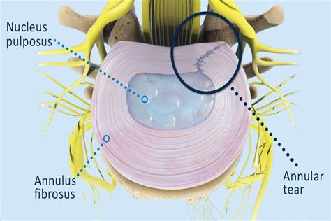 annular ligament tear test|annular ligament tear treatment.